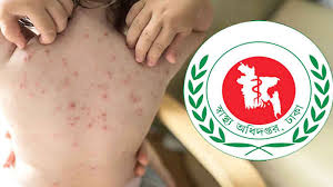 দেশজুড়ে ২৪ ঘণ্টায় হাম উপসর্গে চারজনের মৃত্যু