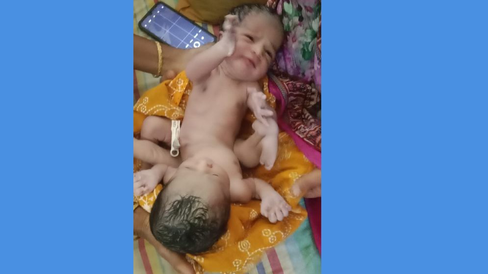 চাঁদপুরে দুই মাথা নিয়ে শিশুর জন্ম